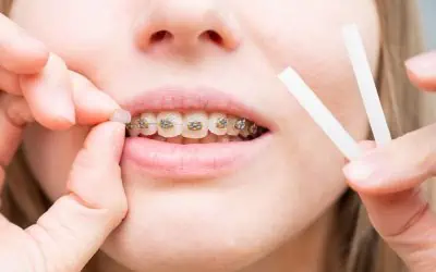 What is orthodontic wax and how to use it?