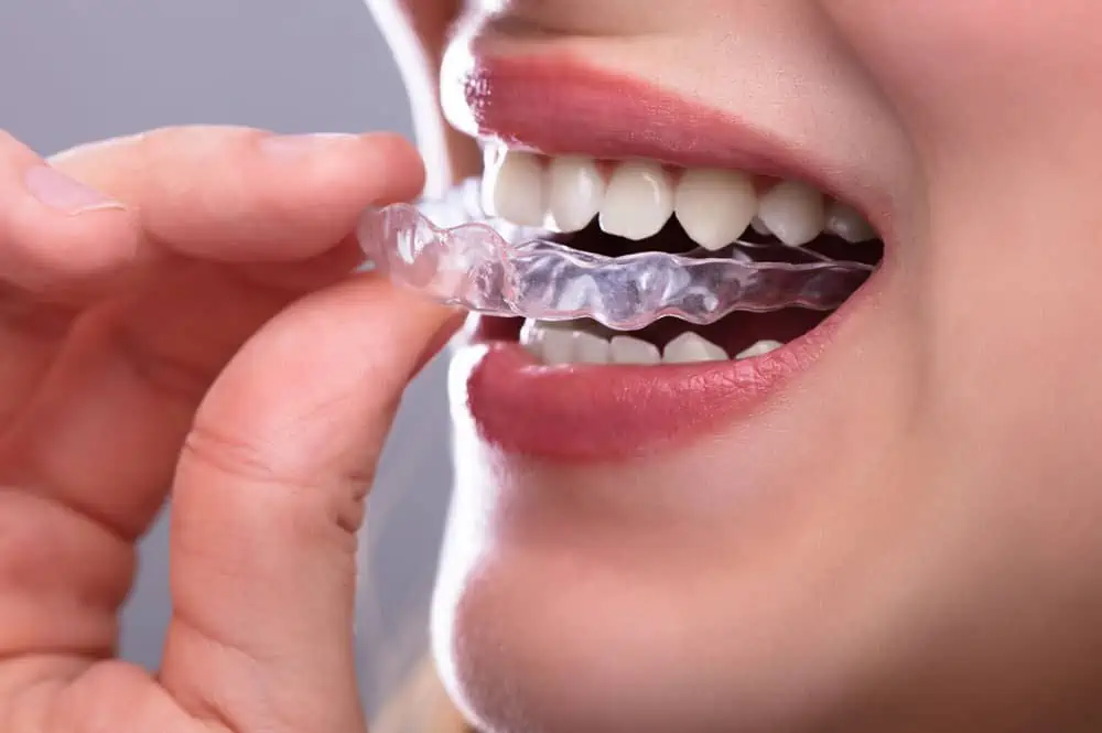 Are Chewies Really Necessary For Invisalign Aligners