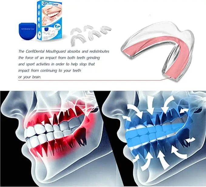 Bruxism Mouth Guard Tooth Grinding Bruxism Mouth Guard Tooth Grinding